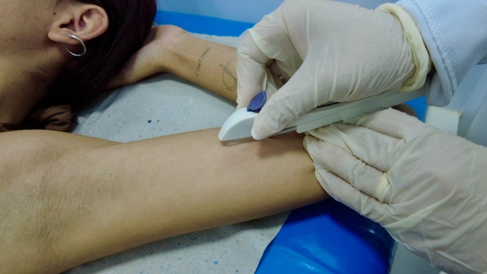 Prefeitura realiza ação de saúde e insere mais de 30 implantes contraceptivos em mulheres em situação de rua